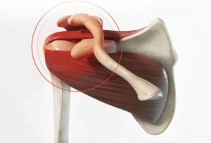 Fracture de l’épaule