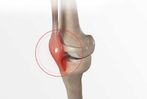 Inflammation du tendon