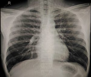 Radiographie du thorax