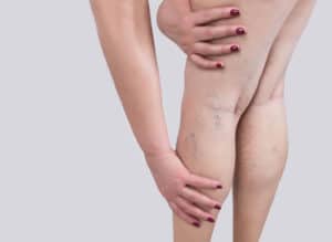 Thrombose veineuse