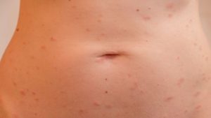 Pityriasis rosé de Gibert