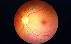Rétinopathie diabétique