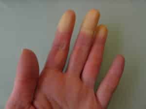 Syndrome de Raynaud