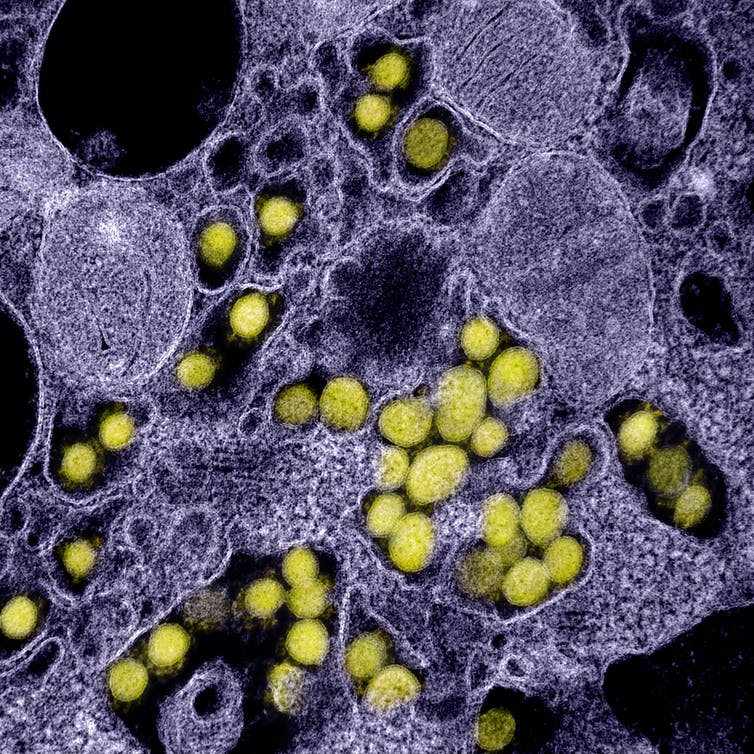 Le virus de la Covid est visible par microscopie électronique dans les tissus