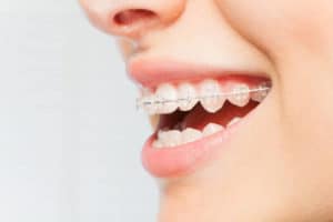 mutuelle orthodontie adulte